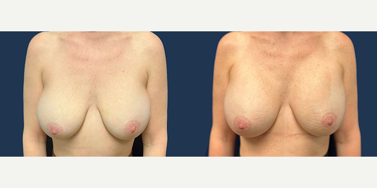 Breast Augmentation with Lift procedure image