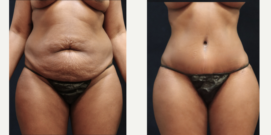 Tummy Tuck (Abdominoplasty) procedure image