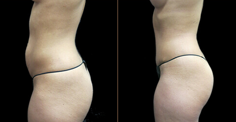 Mommy Makeover procedure image