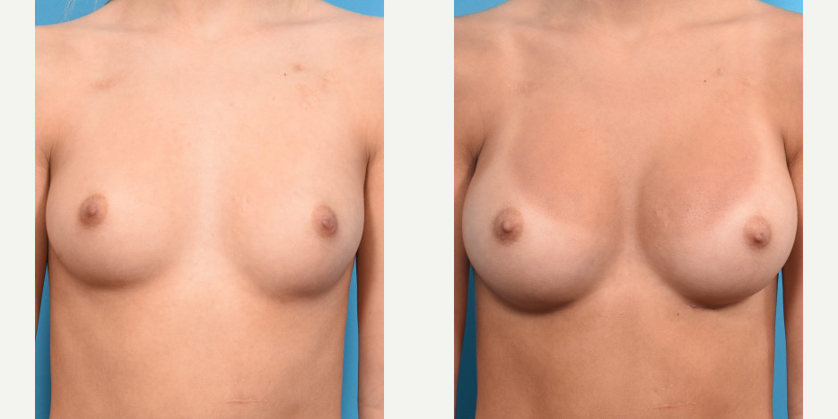 Breast Augmentation procedure image