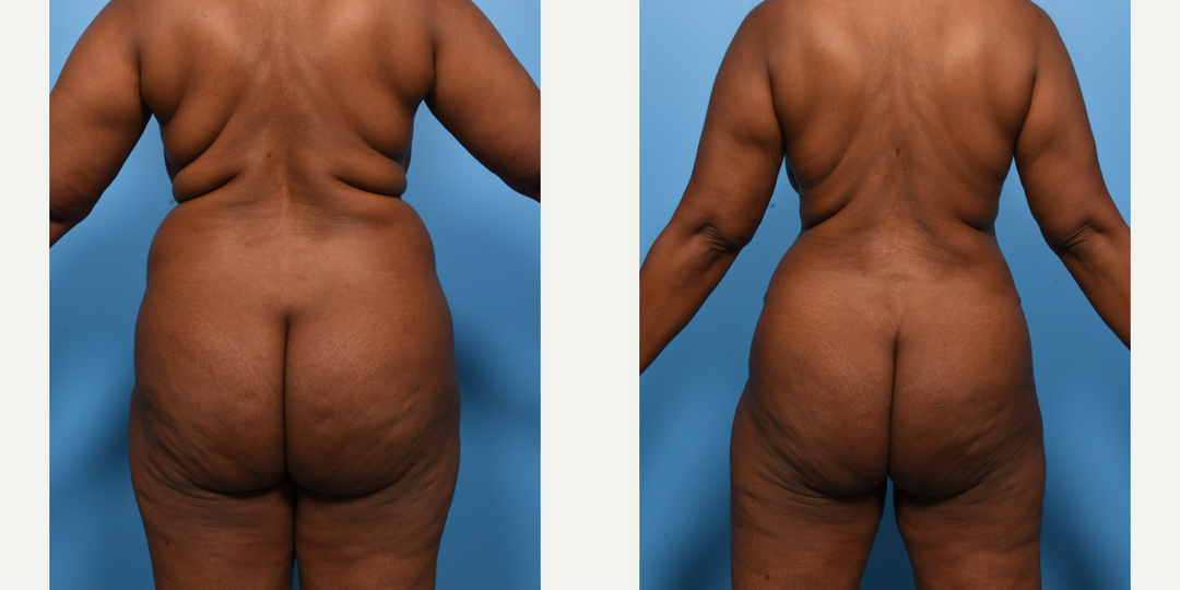 Body Lift procedure image