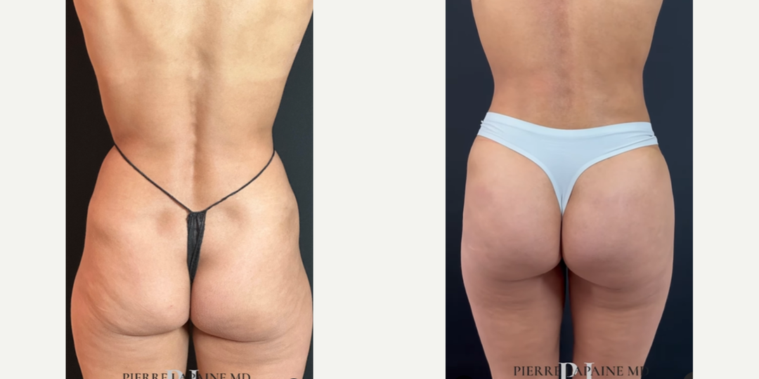 Liposuction procedure image