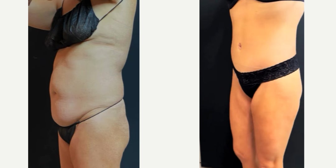 Breast Lift (Mastopexy) procedure image