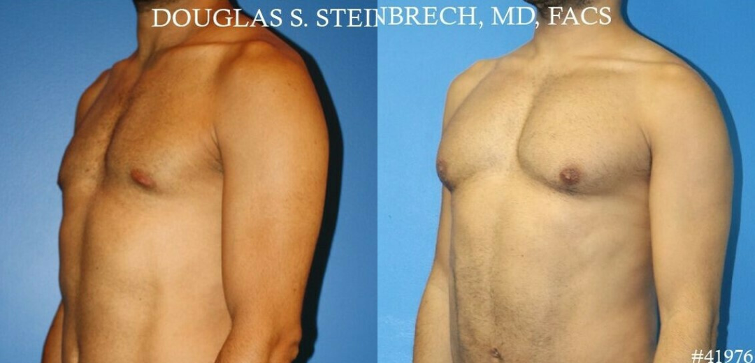 Skin Tightening procedure image