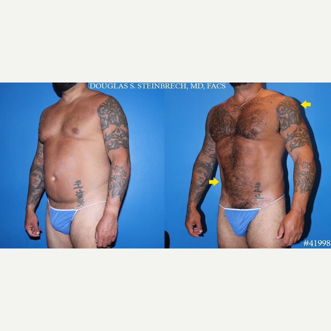 Tummy Tuck (Abdominoplasty) procedure image