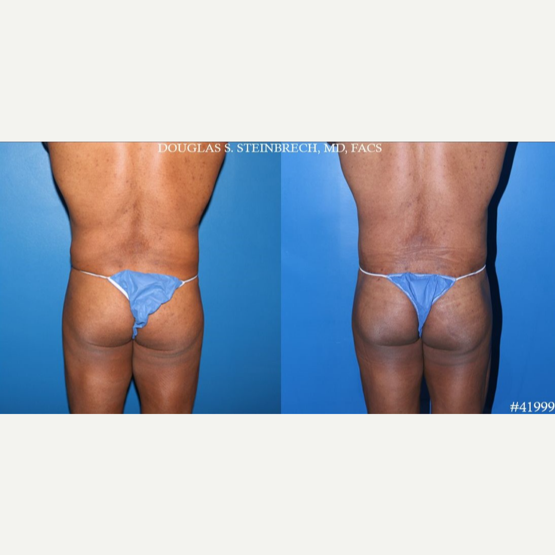 Body Lift procedure image