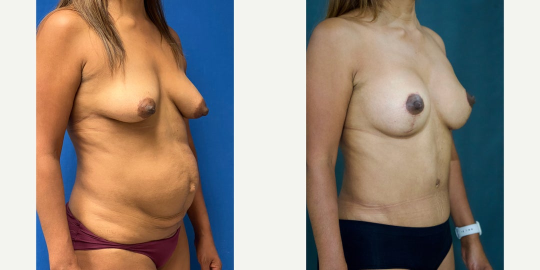 Tummy Tuck (Abdominoplasty) procedure image