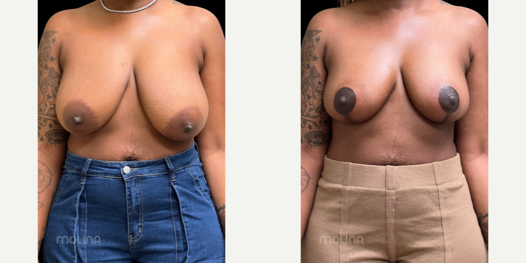 Breast Lift (Mastopexy) procedure image