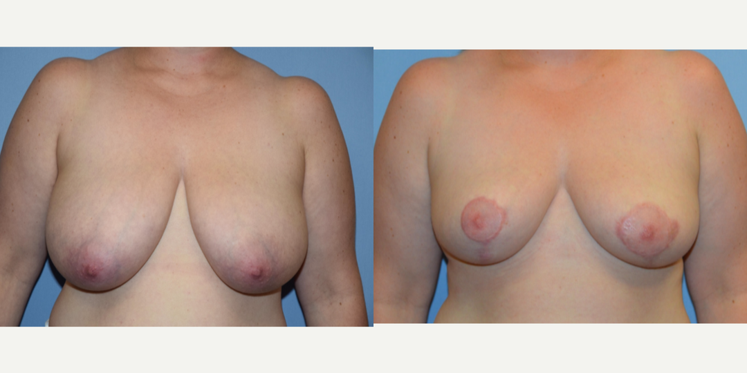 Breast Augmentation procedure image