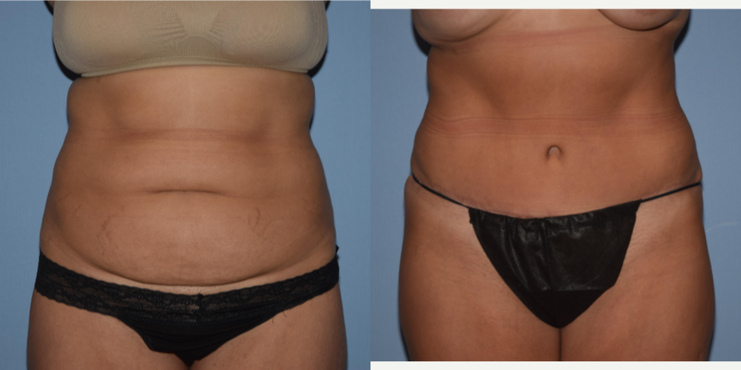 Tummy Tuck (Abdominoplasty) procedure image
