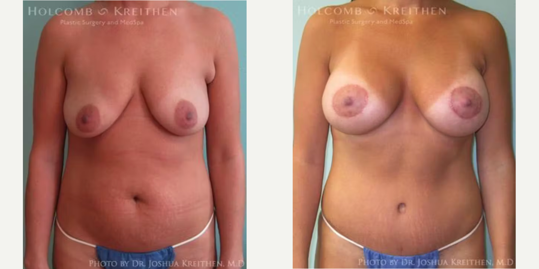 Breast Augmentation procedure image
