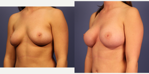 Mommy Makeover procedure image