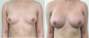 Breast Augmentation procedure image
