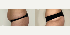 Skin Tightening procedure image