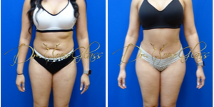 Mommy Makeover procedure image