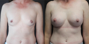 Breast Augmentation procedure image