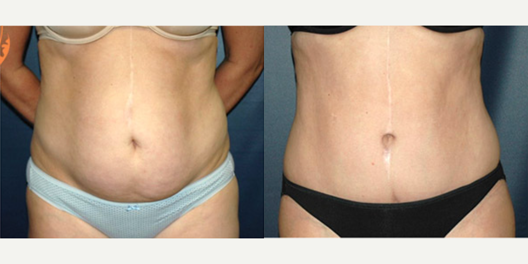 Mommy Makeover procedure image