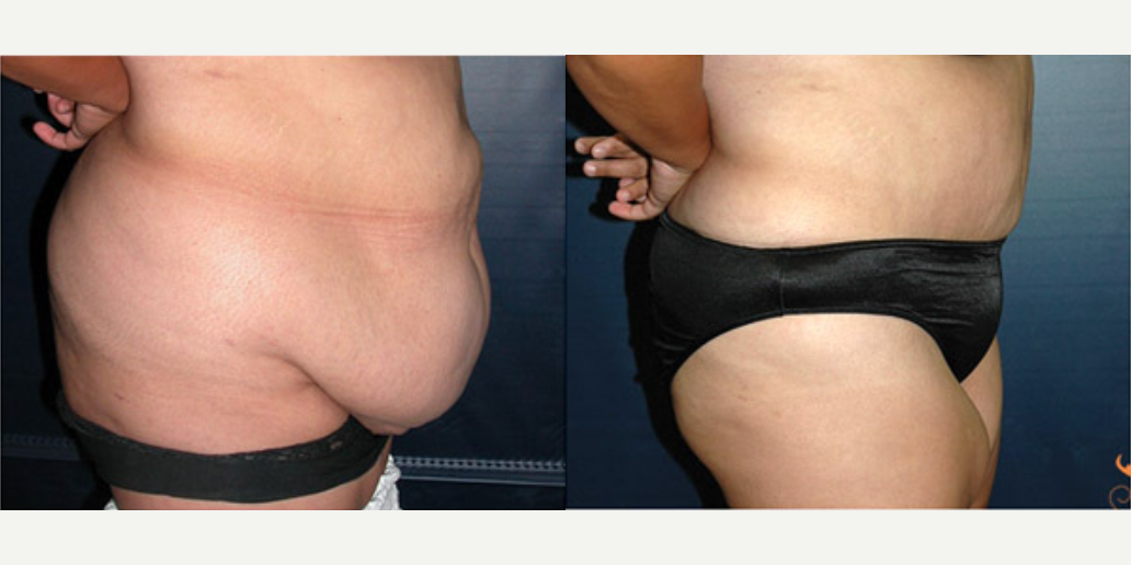 Skin Tightening procedure image