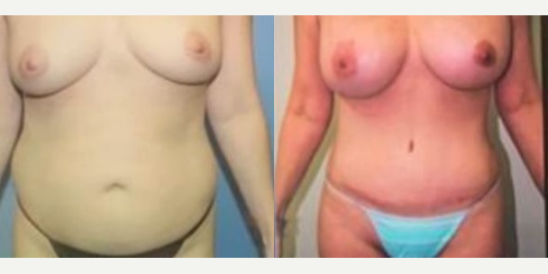 Tummy Tuck (Abdominoplasty) procedure image