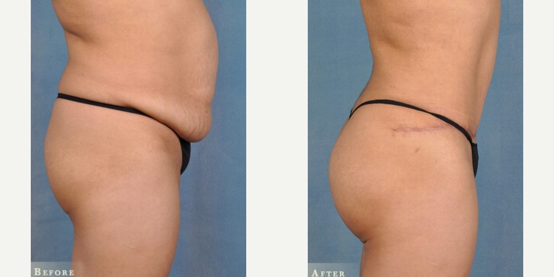 Skin Tightening procedure image