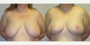 Mommy Makeover procedure image