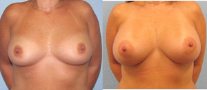 Breast Augmentation procedure image