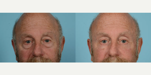 Eyelid Surgery (Blepharoplasty) procedure image