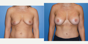 Skin Tightening procedure image