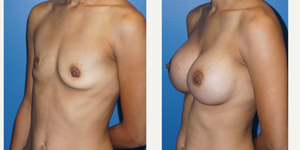 Mommy Makeover procedure image