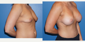 Breast Augmentation procedure image
