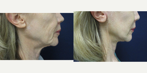 Facelift procedure image