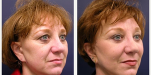 Eyelid Surgery (Blepharoplasty) procedure image