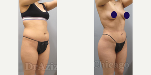 Hip Enhancement procedure image