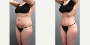 Mommy Makeover procedure image