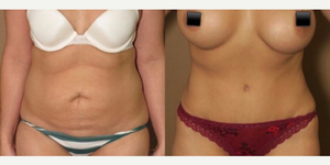 Mommy Makeover procedure image