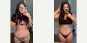 Mommy Makeover procedure image