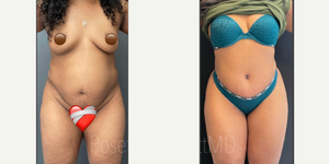 Tummy Tuck (Abdominoplasty) procedure image