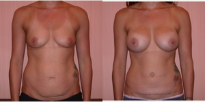 Mommy Makeover procedure image