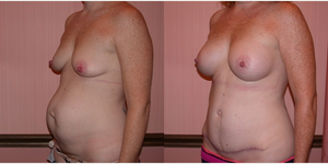 Tummy Tuck (Abdominoplasty) procedure image