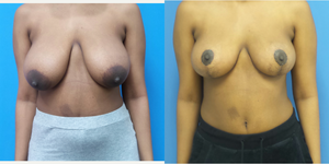 Mommy Makeover procedure image