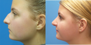 Rhinoplasty (Nose Job) procedure image