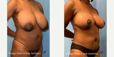 Breast Reduction (Mammoplasty) procedure image