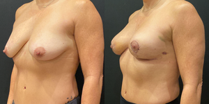 Breast Augmentation procedure image