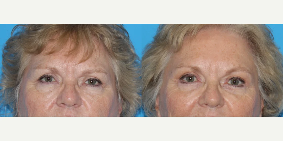 Eyelid Surgery (Blepharoplasty) procedure image