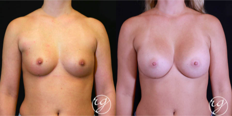 Mommy Makeover procedure image