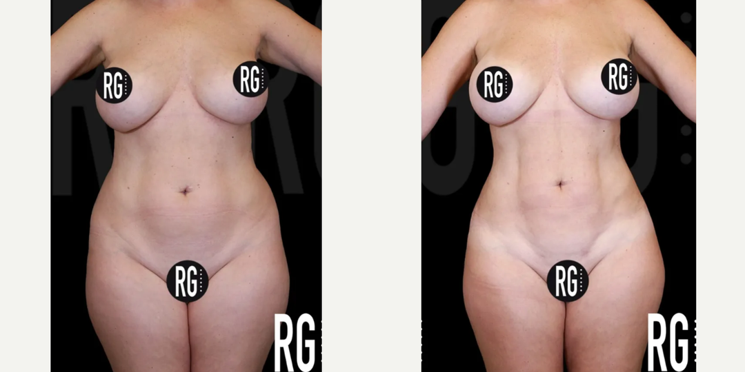 Body Lift procedure image