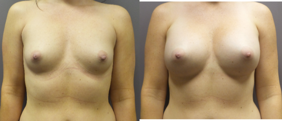 Mommy Makeover procedure image