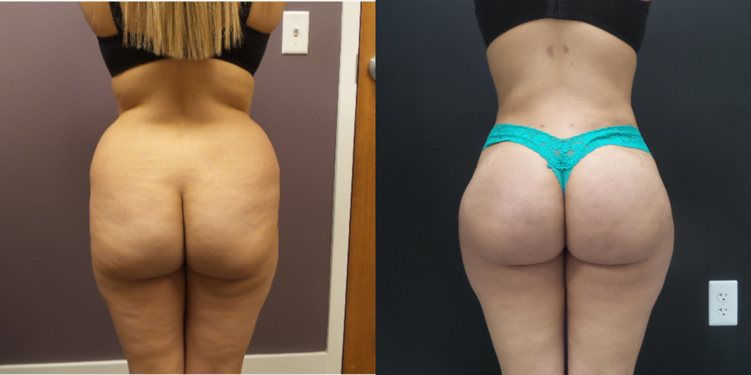 Brazilian Butt Lift (BBL) procedure image