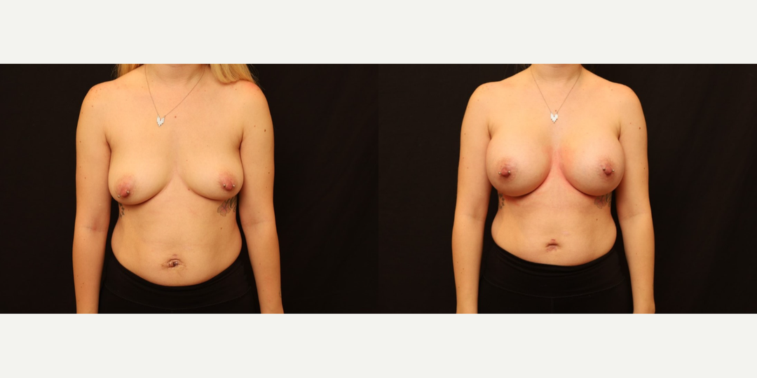 Breast Augmentation procedure image