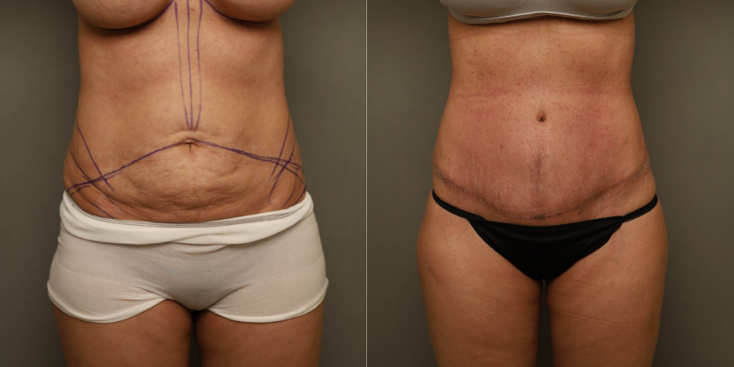 Tummy Tuck (Abdominoplasty) procedure image